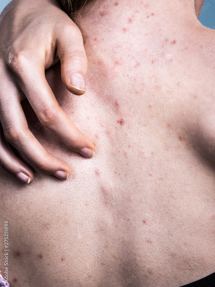Woman with skin problem acne on back Woman with skin problem acne on back