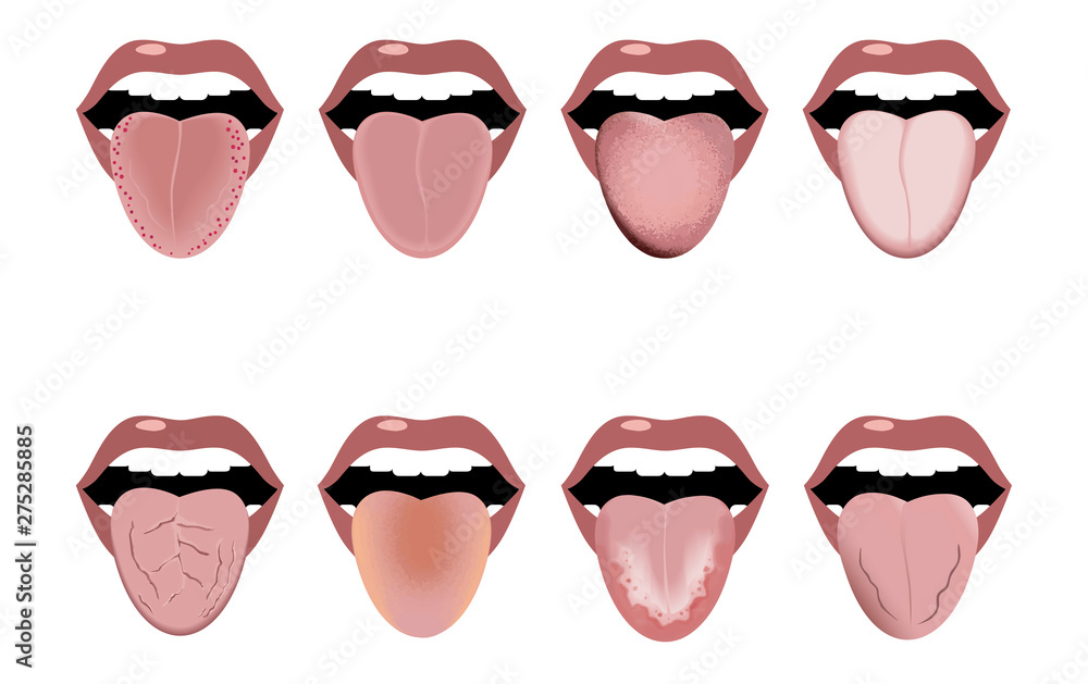 Definition of the disease by tongue. Open mouth and tongue sticking out. Changes in color and appearance in diseases. Vector image. Definition of the disease by tongue. Open mouth and tongue sticking out. Changes in color and appearance in diseases. Vector image.