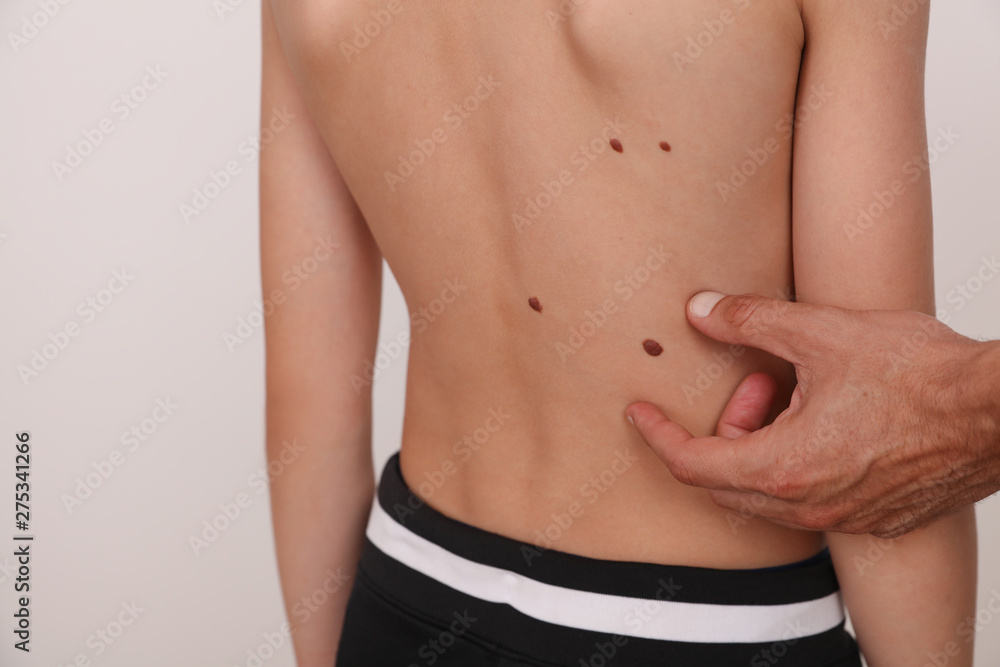 Naklejka premium Doctor dermatologist examines child patient birthmark close up. Mole checkup. Skin tags removal