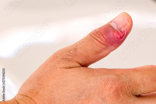 Paronychia, swollen finger with fingernail bed inflammation due to bacterial infection on a toddlers hand. finger swollen with inflammation due to Nail ripped infection.