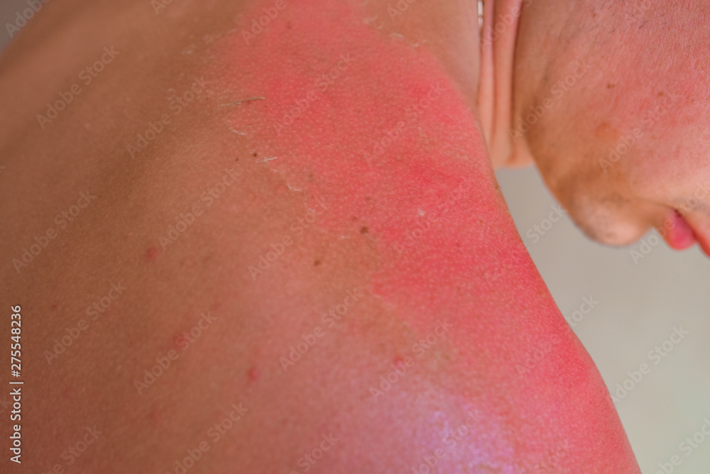 Sunburned man. Sunburned heavily, white skin versus very dark red and burned Sunburned man. Sunburned heavily, white skin versus very dark red and burned