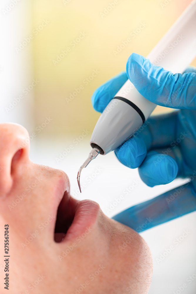 Young man visiting the dental office. Dentist hands in protective gloves using ultrasound to clean patient's teeth. Closeup of open mouth. Young man visiting the dental office. Dentist hands in protective gloves using ultrasound to clean patient's teeth. Closeup of open mouth.