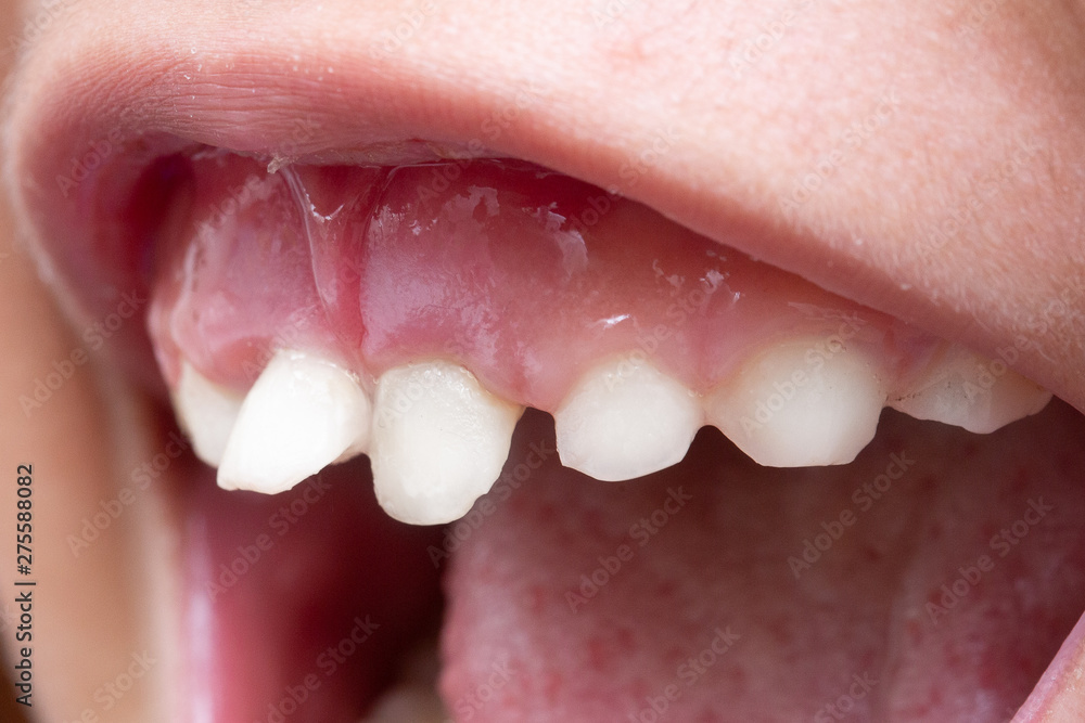 Obraz premium Crooked teeth in children