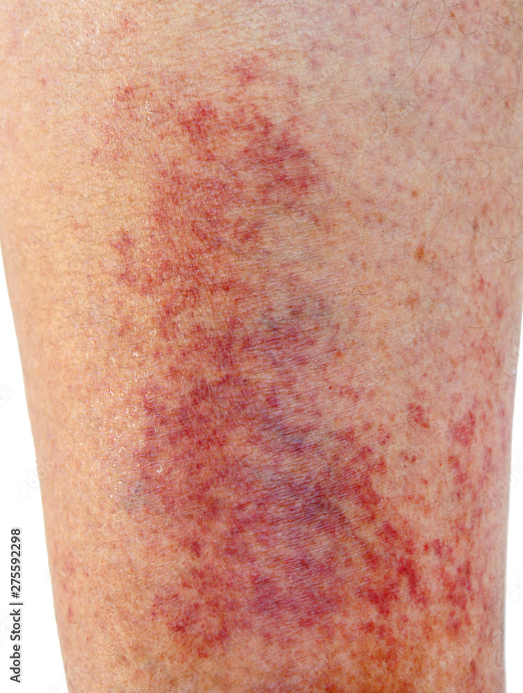 Allergic contact dermatitis at shin Stock Photo Adobe Stock