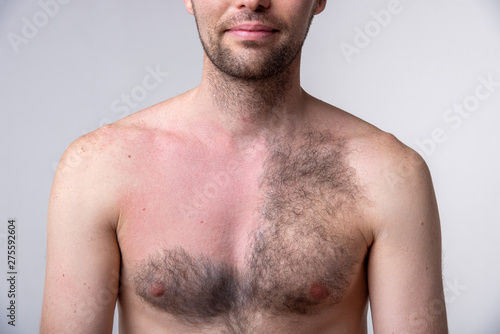 Handsome man with a lot of hair on one side of the chest and another part of the breast after waxing