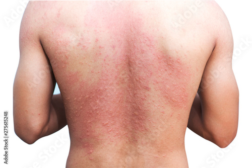 one man with skin rash on back