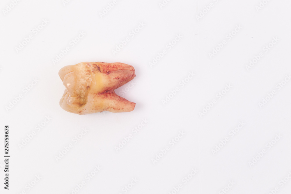 Caries on the teeth on the white background
