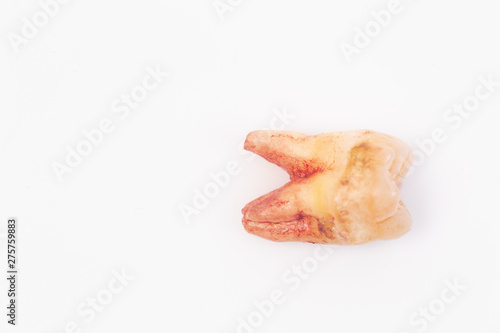 Caries on the teeth on the white background