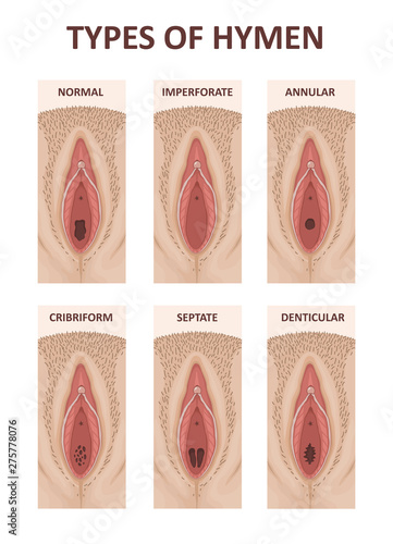 Types of Hymens. Female anatomy vagina photo
