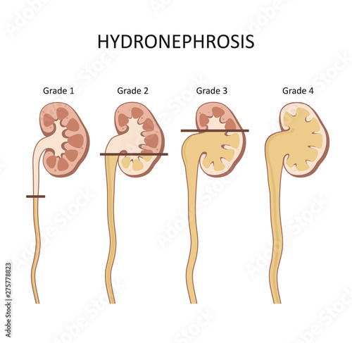 Hydronephrosis stage.