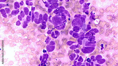 Fine needle aspirate (FNA) cytology of a lung tumor in a smoker showing small cell (oat cell) carcinoma, a type of lung cancer, with characteristic nuclear molding.   photo