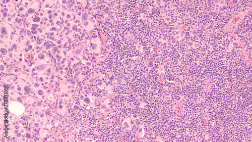 Obraz na plátne Breast Cancer; lymph node metastasis: Microscopic image of cross section of a  sentinel axillary lymph node with invasion by metastatic infiltrating ductal carcinoma (tumor cells left)