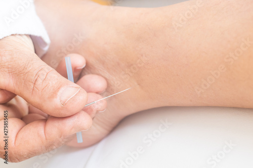 Acupuncture needles on the legs and foot
