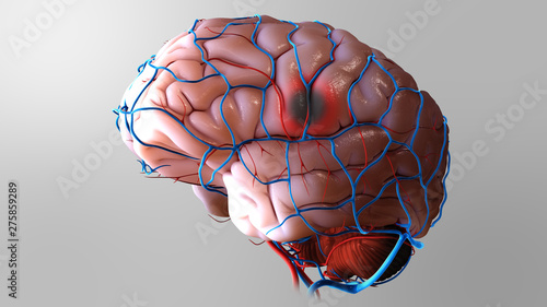 Tableau sur toile 3D Brain Stroke Illustration