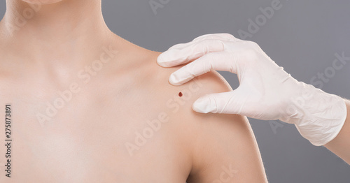 Dermatologist examining birthmark on woman shoulder, panorama photo