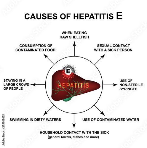 Causes of Hepatitis E. World Hepatitis Day. Infographics. Vector illustration on isolated background.