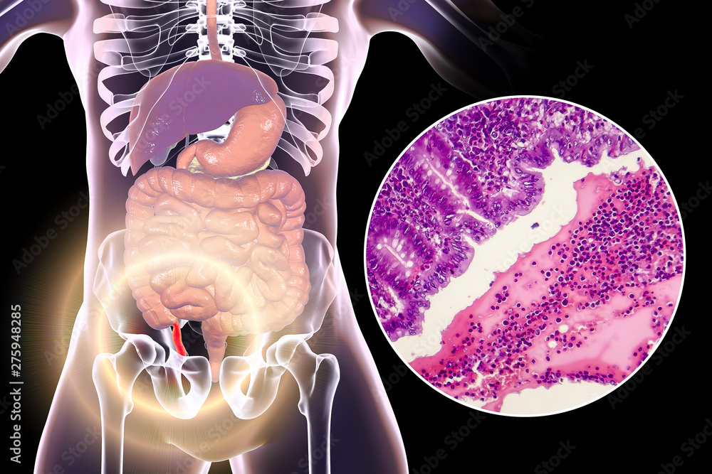 Acute suppurative appendicitis, 3D illustration of human body with ...