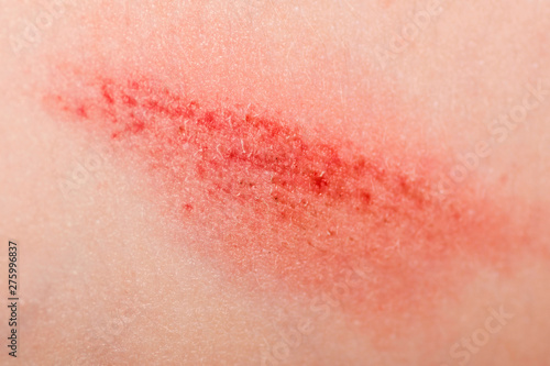 A wound on the human body. Very close up of painful wound