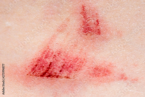 A wound on the human body. Very close up of painful wound