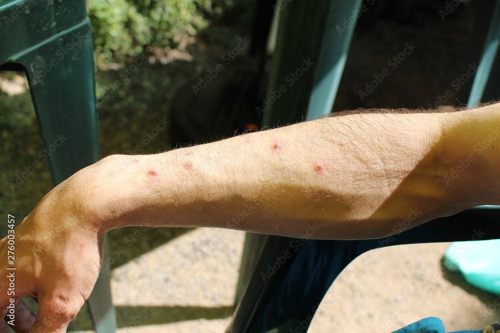 bras : piqure de moustique enété
