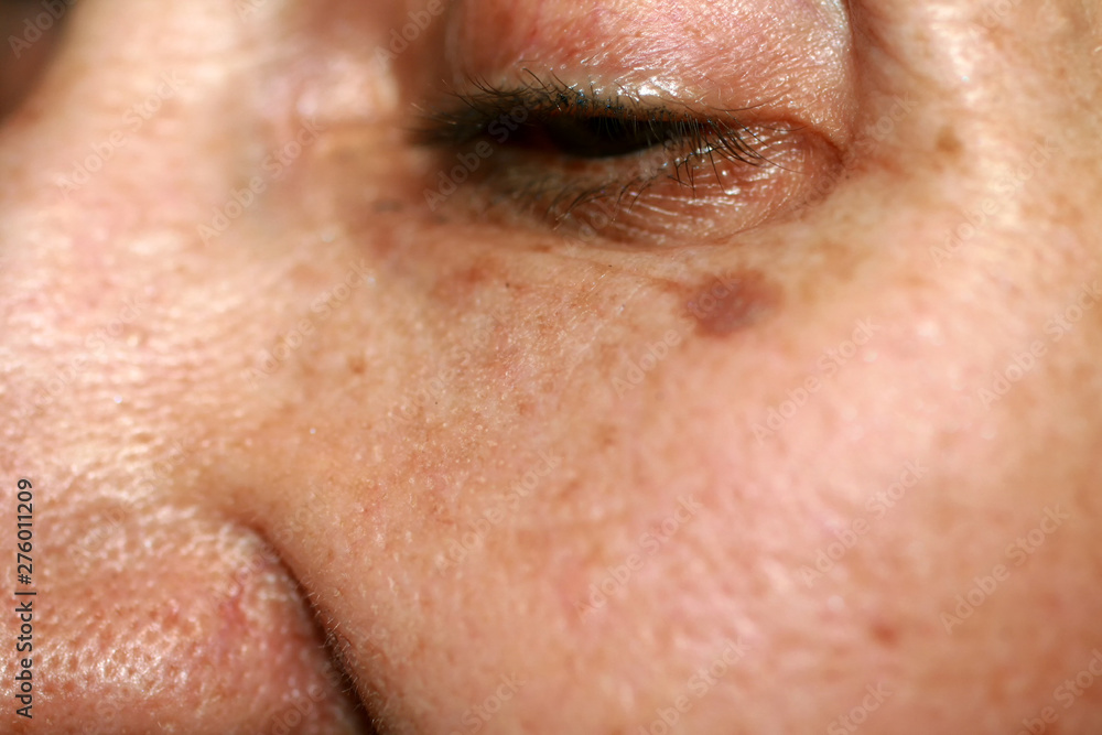 Pigmentation on the face. Brown spot on cheek. Pigment spot on the skin. Pigmentation on the face. Brown spot on cheek. Pigment spot on the skin.