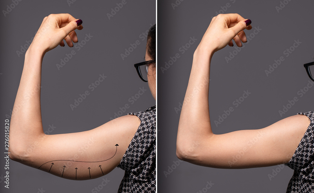 Foto de A before and after view of a successful brachioplasty procedure. An  untoned arm is seen on the left before plastic surgery, and a toned arm is  seen on the right