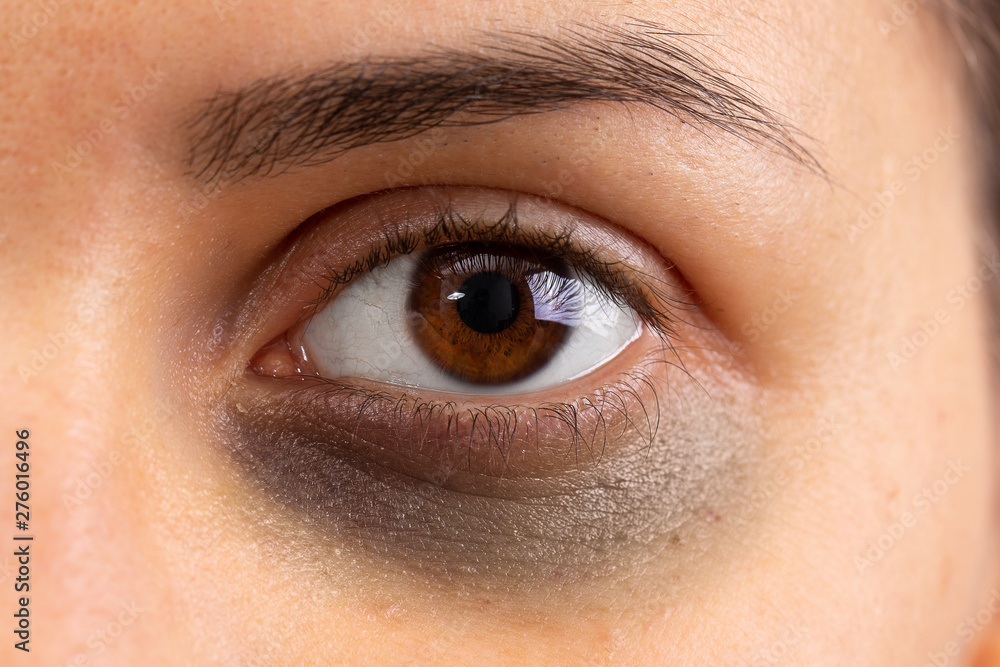 An extreme close up view on a beautiful girl with a black eye. Contusion in the lower eye area