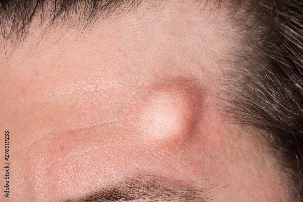 A large hematoma is seen up close on the forehead of a Caucasian man. Large raised lump symptom of a head trauma with copy space on the left. A large hematoma is seen up close on the forehead of a Caucasian man. Large raised lump symptom of a head trauma with copy space on the left.