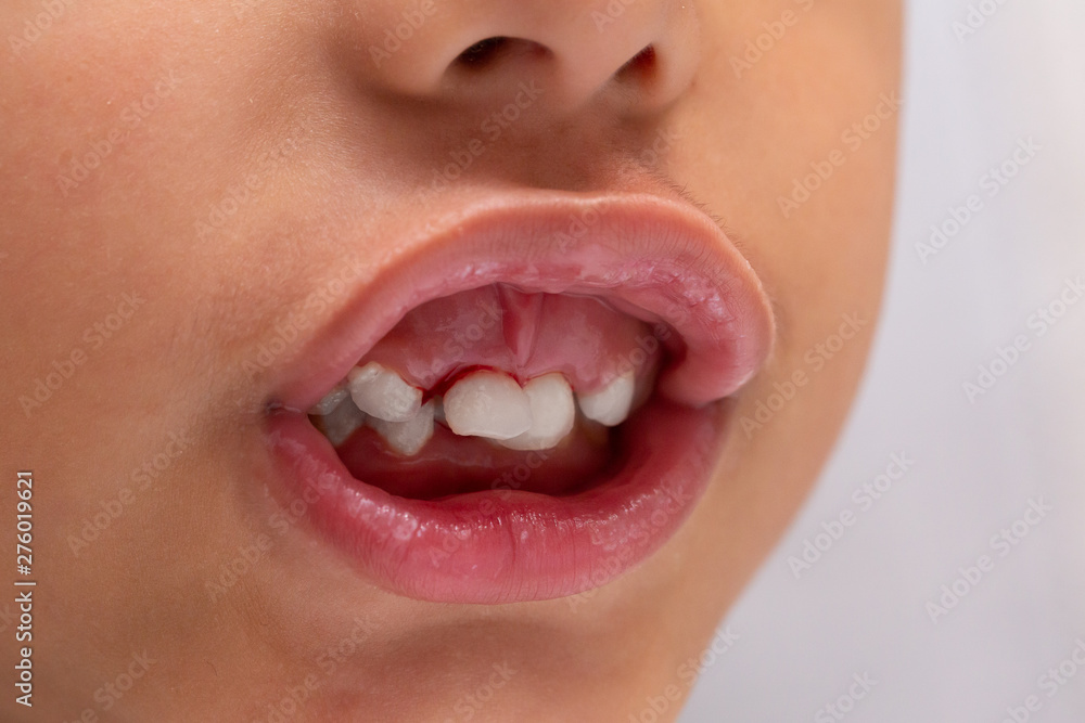 Obraz premium An extreme close up view on the mouth of a young boy with loosened incisors. Bleeding gum as child grows up and loosed milk teeth.