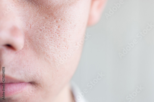 Close up image of half face Asia male with wide pores skin problem photo