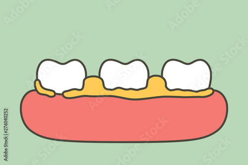plaque or tartar, cause of tooth periodontal disease - dental cartoon vector flat style