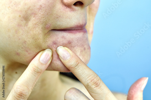 Fotografie Acne pus, Close up photo of acne prone skin problem, Woman squeezing pimple with dirty bare hands, Removing whitehead acne from face and left lesion scar