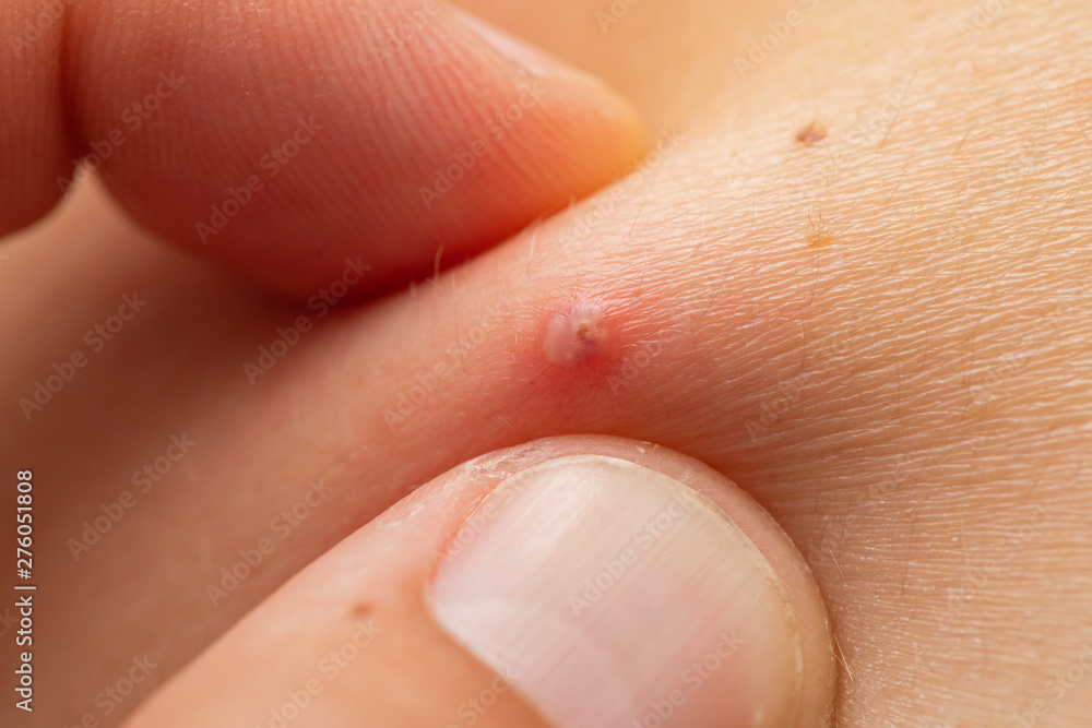 Red pimple filled with pus Red pimple filled with pus