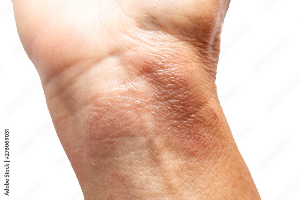 Fototapeta premium thermal burn of the skin on the arm