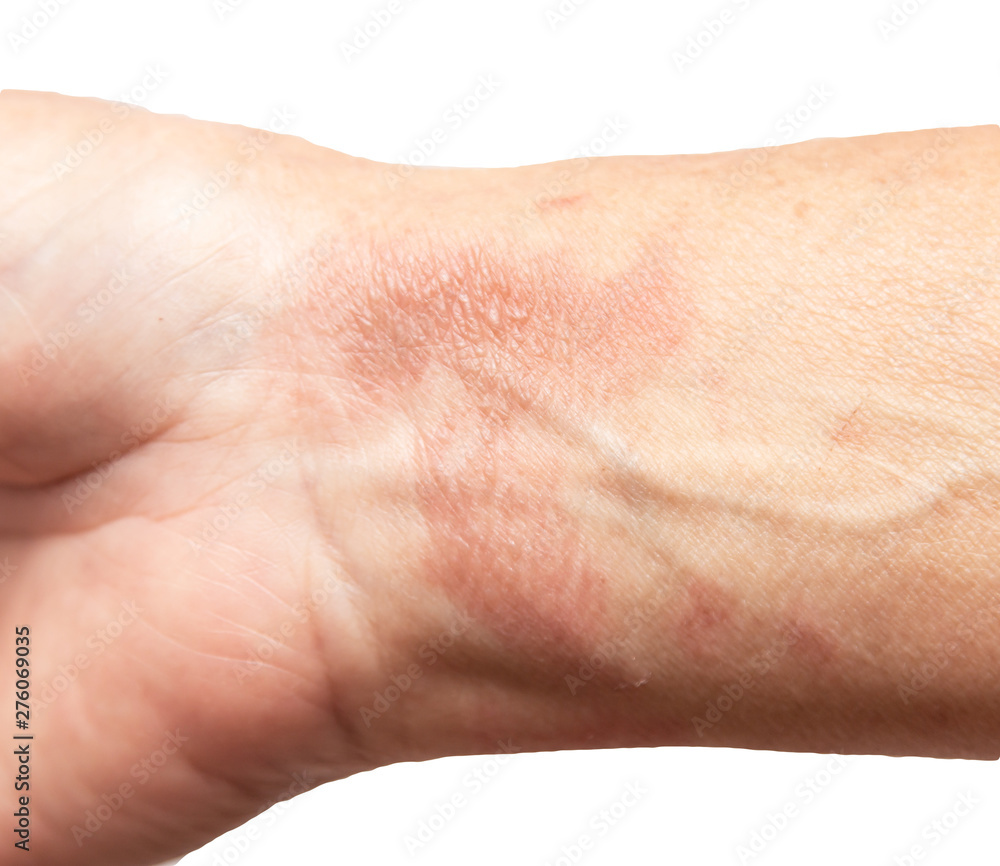 thermal burn of the skin on the arm thermal burn of the skin on the arm