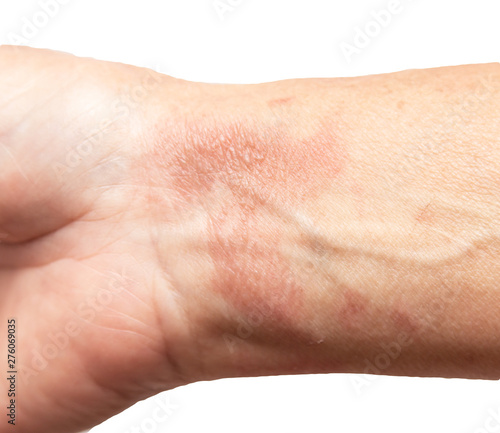 thermal burn of the skin on the arm © studybos