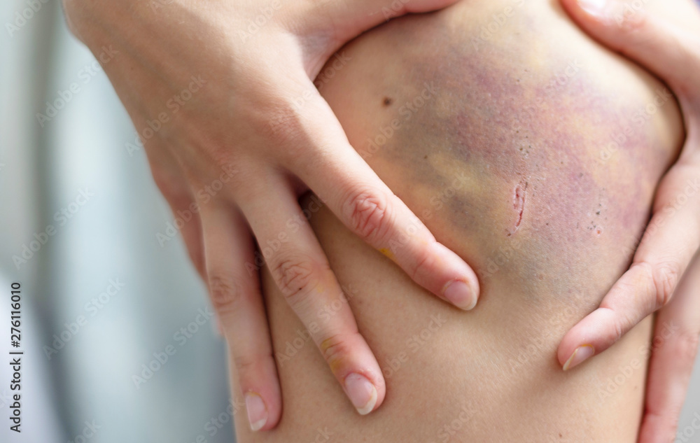bruise on hip of a child bruise on hip of a child
