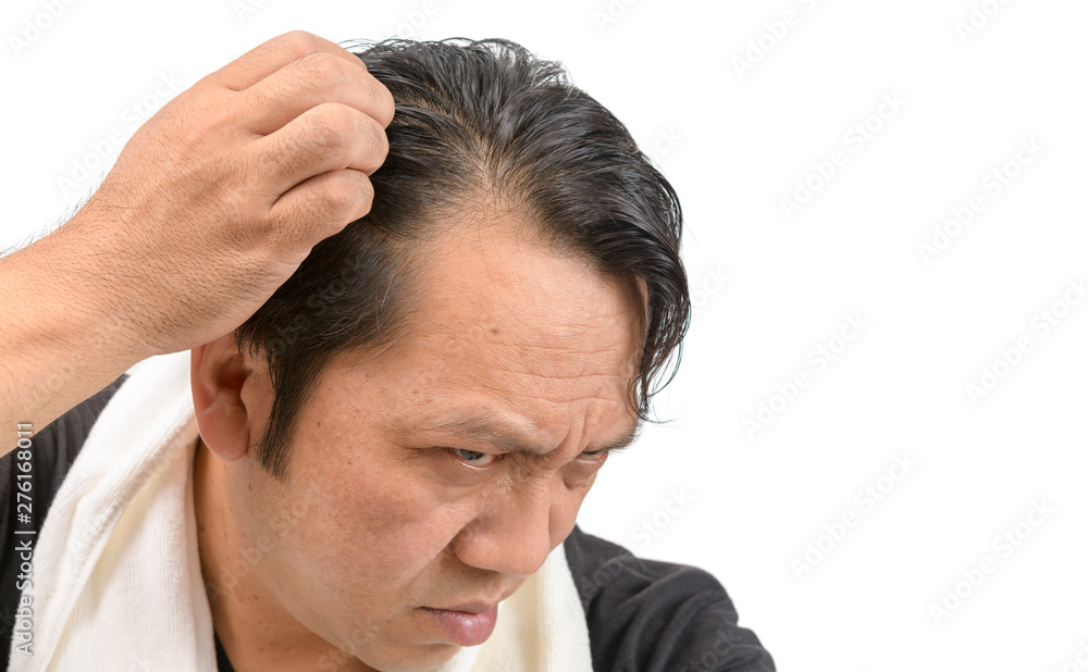asian man worry about his hair loss or alopecia isolated asian man worry about his hair loss or alopecia isolated