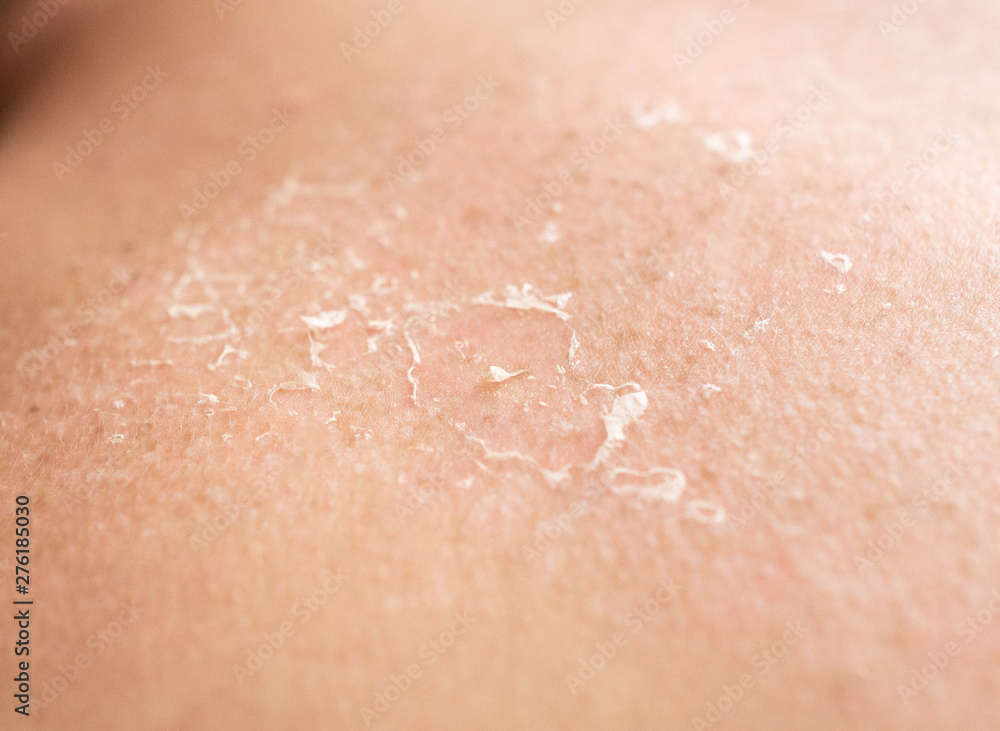 Fototapeta premium Flaking of the skin after sunburn on the back of a person, sunburn, close-up, epidermis