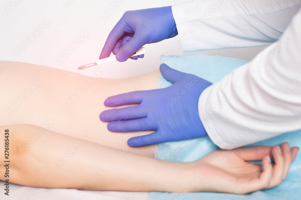 Fototapeta premium Doctor holding a surgical scalpel near the spine of the girl concept of spinal surgery diskectomy and laminectomy