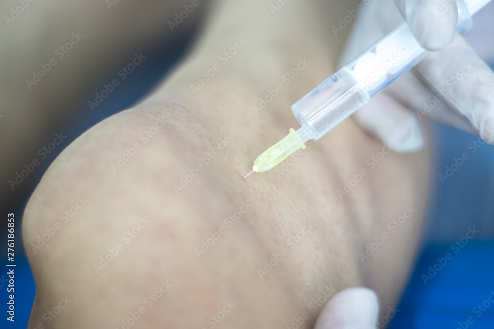 EPI needling physical therapy EPI needling physical therapy
