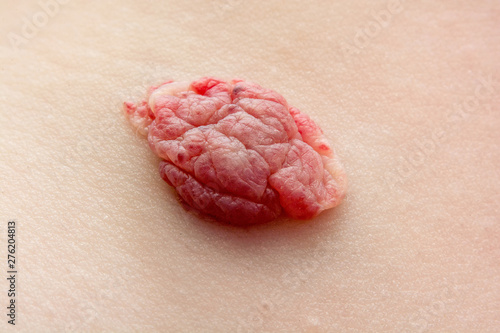 Obraz na płótnie Infantile hemangioma red birthmark (also called strawberry mark) on the baby's chest. Vascular tumor (IHs). Regression stage. Close up shot w salonie