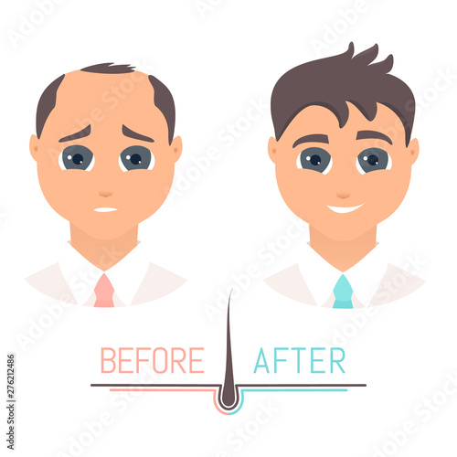 Man with thinning hair before and after hair loss transplantation. Male pattern baldness set with follicle diagram. Treatment result outcome front view. Alopecia infographics medical vector template.