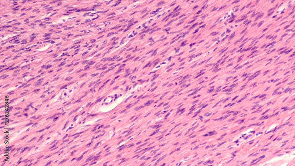 Photomicrograph of a malignant peripheral nerve sheat tumor (neurogenic sarcoma), a type of cancer derived from peripheral nerves.