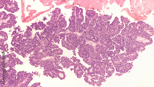 Bladder Cancer: Photomicrograph of a high grade, non-invasive papillary transitional (urothelial) carcinoma from a biopsy of a patient with hematuria (blood in urine) obtained during cystoscopy.