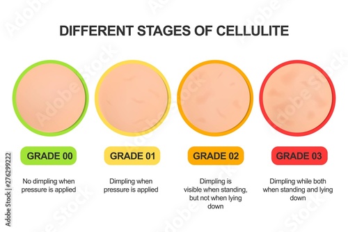 Different stages of cellulite. Grading scale. Treatments.