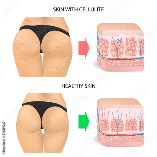Skin cross section of Cellulite formation. Banner with the realistic ass