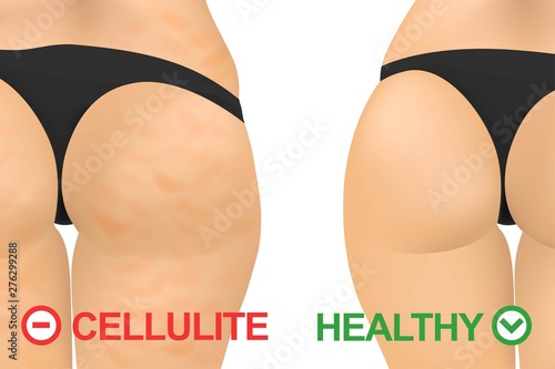 Colorful illustration of woman cellulite. Vector illustration of a fat and thin female body. Isolated white background. The body of a woman before and after losing weight. Belly and breasts of a girl