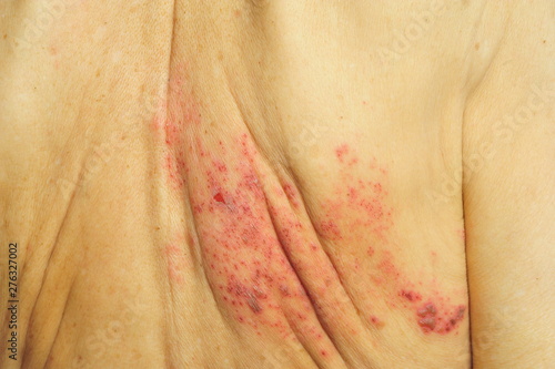 Schilderij op canvas Shingles is a viral infection that causes a painful rash