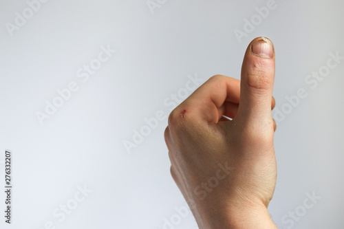 Broken nail close-up , male model hands on white background